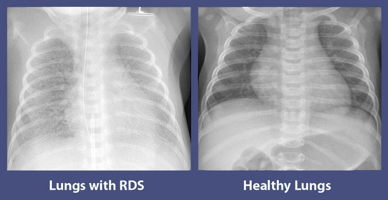 Healthy lungs and lungs with RDS